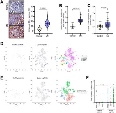 Cluster of differentiation-44 as a novel biomarker of lupus nephritis and its role in kidney inflammation and fibrosis